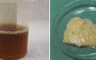 Липкая моча и кал