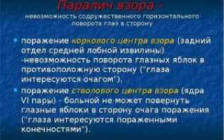 Парез взора