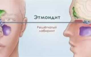 Как вылечить этмоидит?