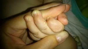 Твёрдый прыщ на пальце у ребёнка