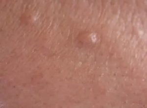 Сальные железы на поверхности полового члена