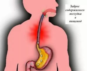 Газы после антибиотиков, горит пищевод, изжога