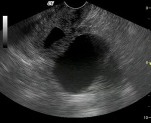 Серозометра при беременности