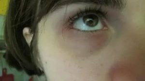 Синяки под глазами с детства