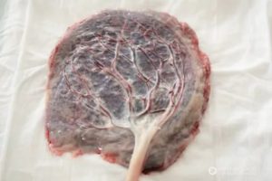 """Рыхлая"" плацента"