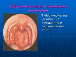 Твёрдый бугор на задней стенке горла