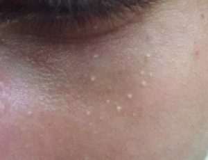 Мелкие белые пузырьки на лице
