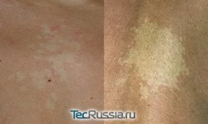 Беспигментный невус или ограниченное витилиго?