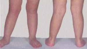 После перелома одна нога короче другой