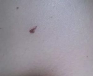 Темная точка на месте удаленной родинки