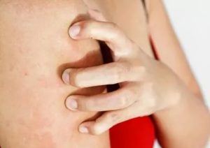 Зуд. Температура