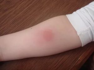 ОАО после манту