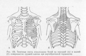 Вертеброгенная торакалгия не проходит. Что делать?
