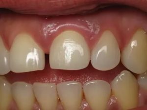 Опухла десна