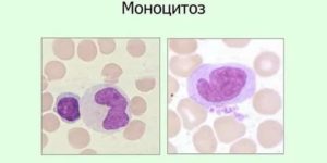 Повышены моноциты% у ребенка 12 лет. Моноцитоз?