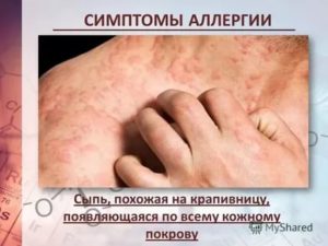 Сыпь похожа на крапивницу