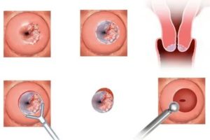 Установка спирали после прижигания эрозии