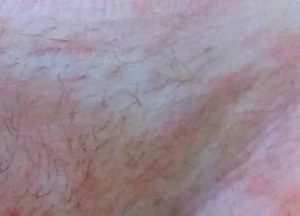 Зуд у ребенка в паху