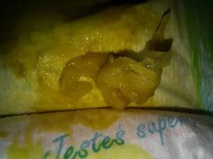 Серые пленки в кале