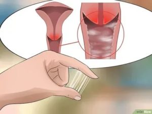 Жжение во влагалище, трещина задней спайки