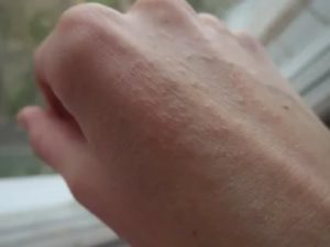 Зуд на внешней стороне ладони, шелушение и корки
