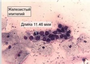 Результат кольпоскопии, пролиферация железистого эпителия