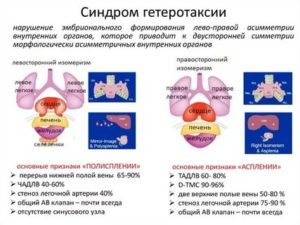 Синдром гетеротаксии