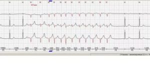 Тахикардия по утрам после сна