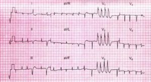 Тахикардия при ходьбе