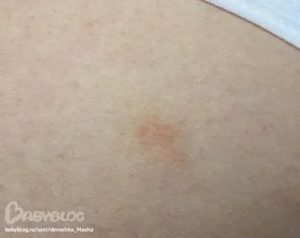 Розовые пятна на попе у ребёнка