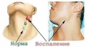 Лимфоузлы и артрит