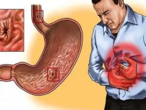 Сильные боли в кишечнике, запоры, эрозивный гастрит