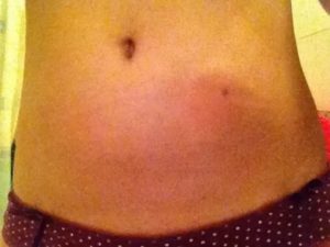 Кровь после укола фраксипарина