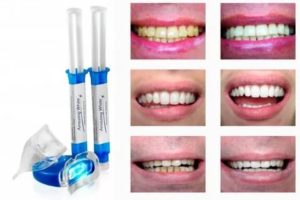 Отбеливание зубов методом Amazing White во время грудного вскармливания