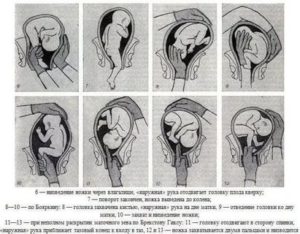 Низкое расположение головки плода