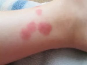 Красное пятно на коже, долго не проходит