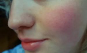 Розовое пятно на щеке