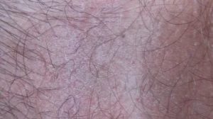 Зуд у ребенка в паху