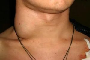 Киста вчп и лимфоузлы шеи
