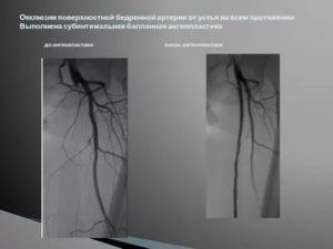 Окклюзия лучевой артерии