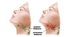 Лимфоузлы и артрит