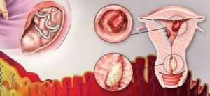 Увеличена матка