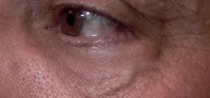 Под кожей века вена?