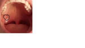 Шишечка около миндалины