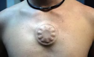 Камушки в сосках