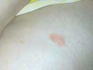 Розовые пятна на попе у ребёнка