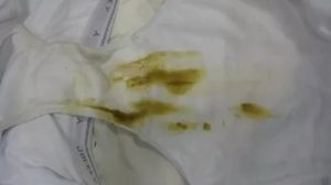 Кал на трусах