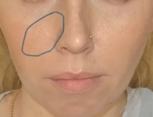 Опухло крыло носа