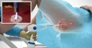 Установка спирали после прижигания эрозии