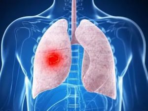 Новобразование в легких